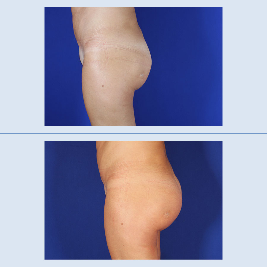 Antes y Después Gluteus Augmentation