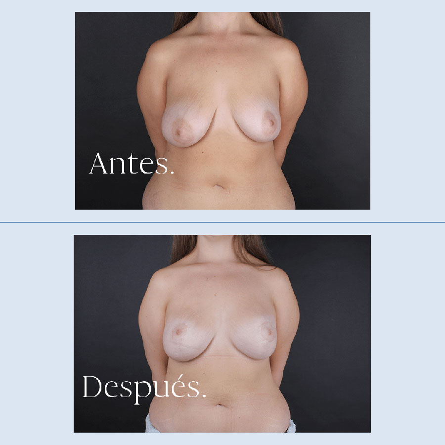 Antes y Después Breast Reduction