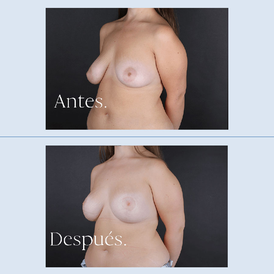 Antes y Después Breast Reduction