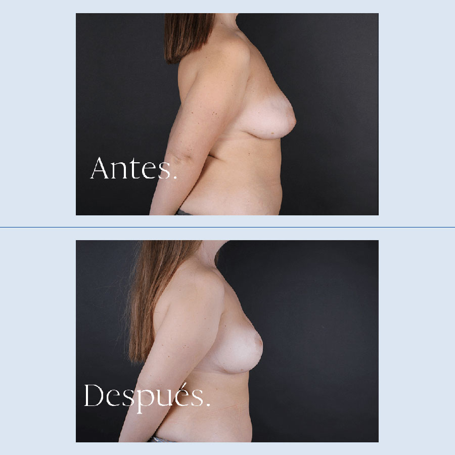 Antes y Después Breast Reduction