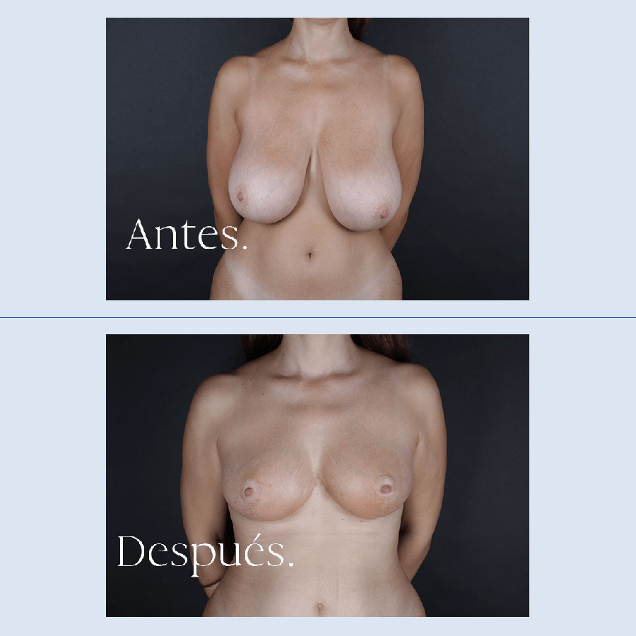 Antes y Después Breast Reduction