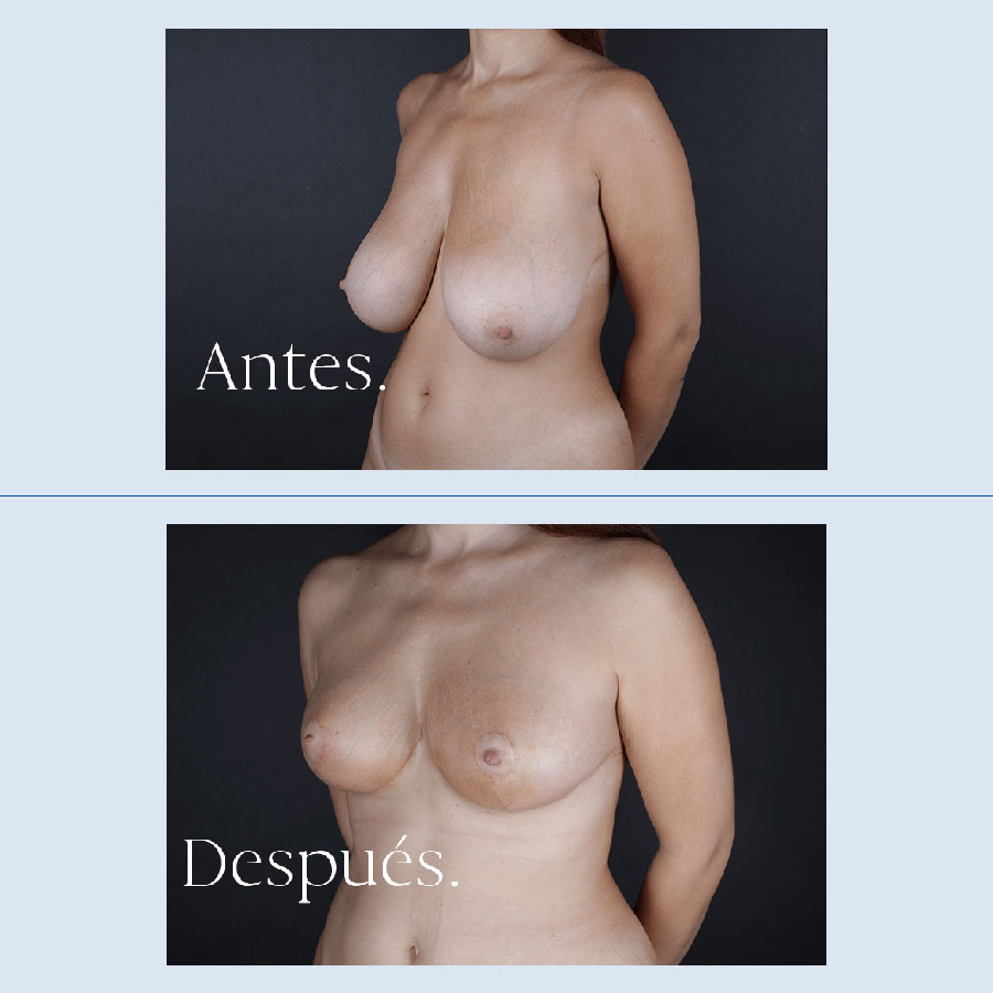 Antes y Después Breast Reduction