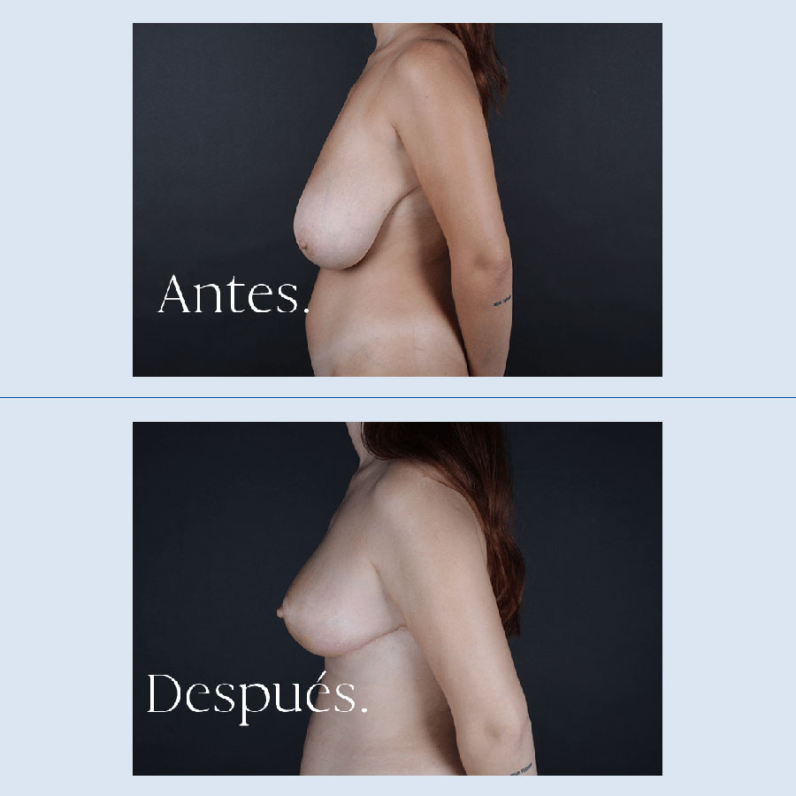 Antes y Después Breast Reduction