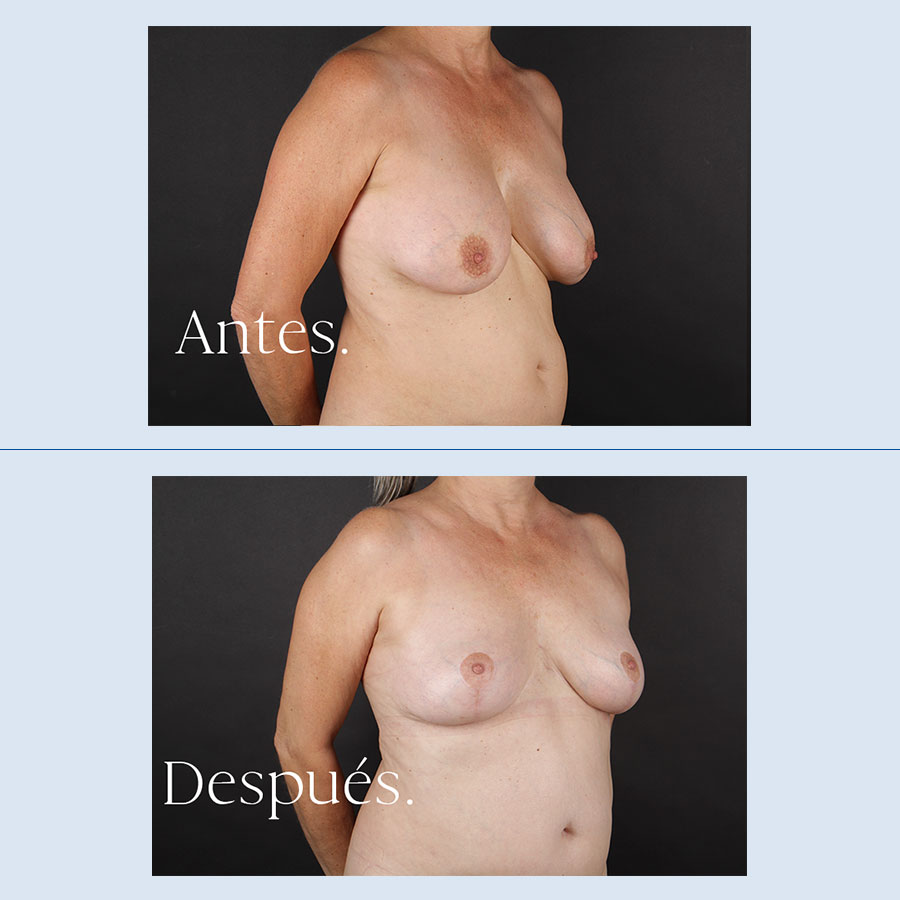 Antes y Después Breast Reduction