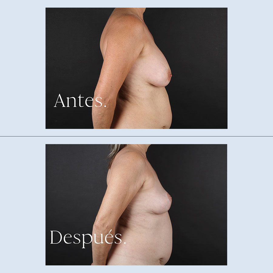 Antes y Después Breast Reduction