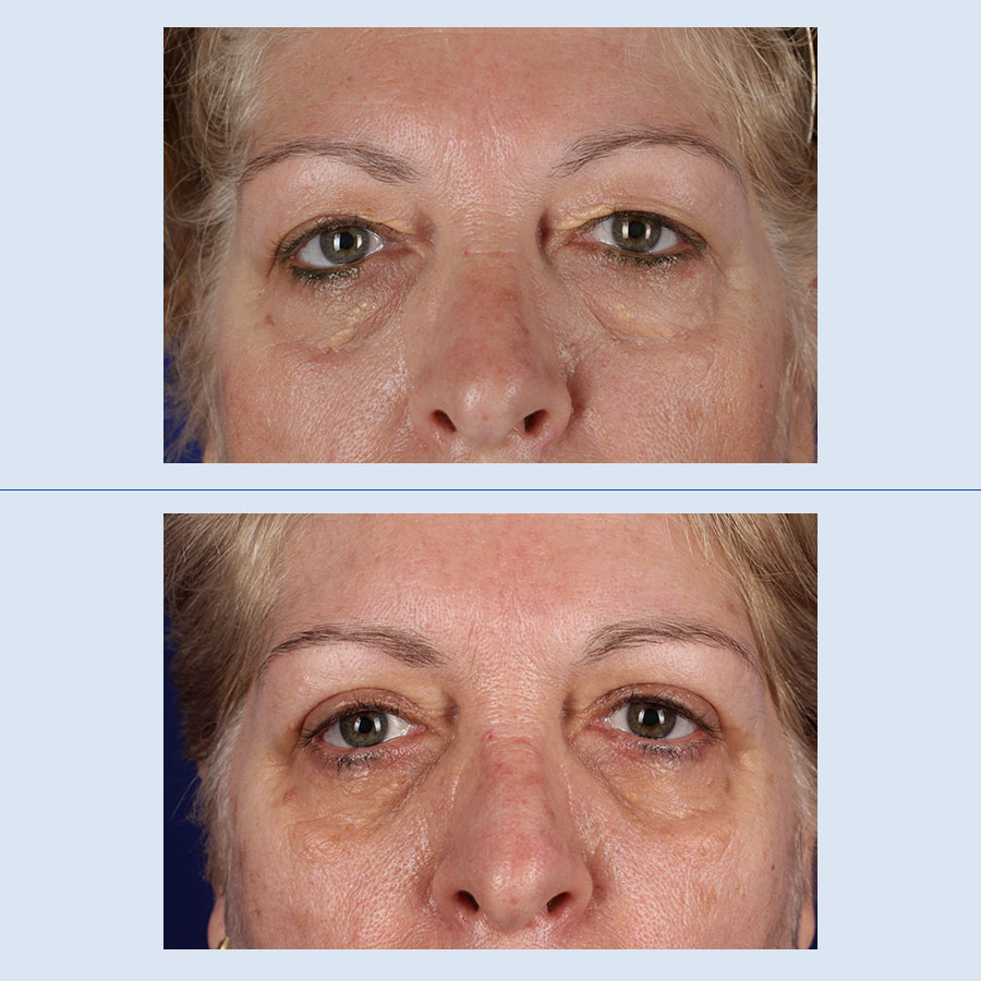 Antes y Después Blepharoplasty