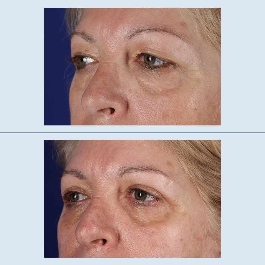 Antes y Después Blepharoplasty