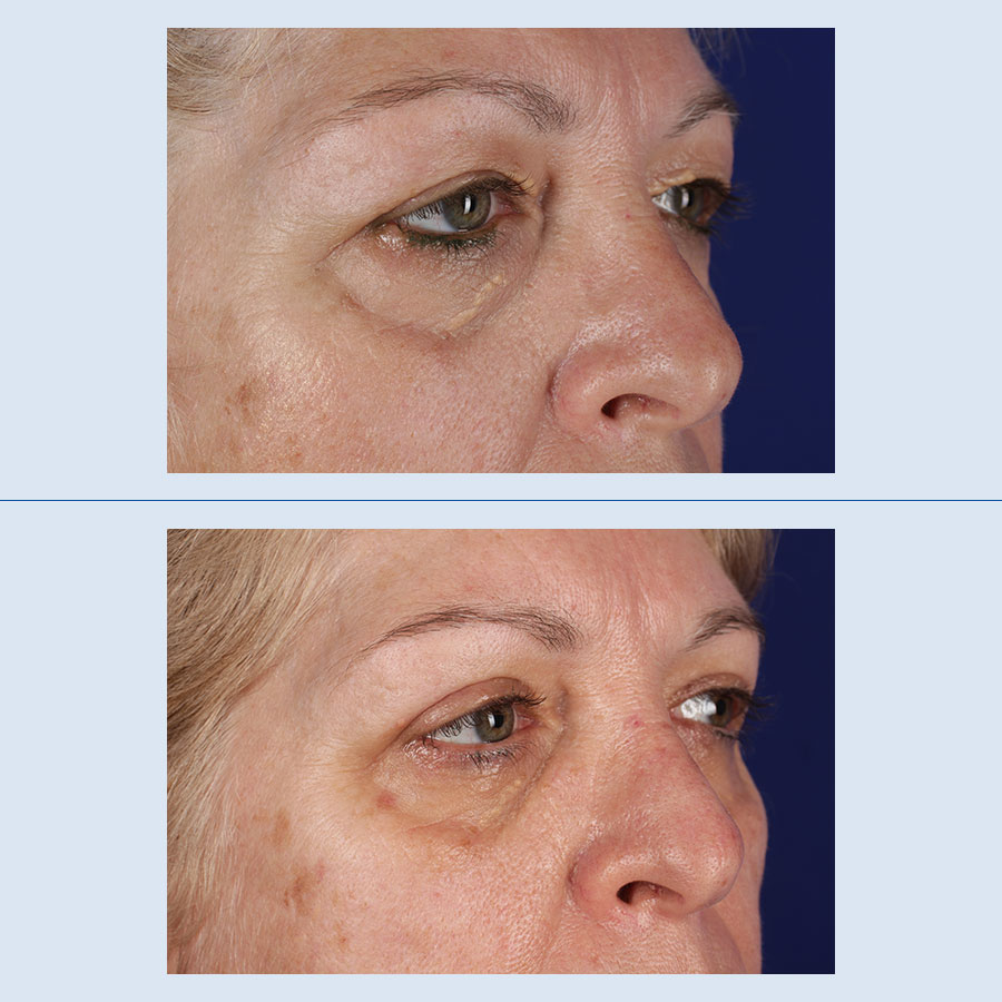 Antes y Después Blepharoplasty