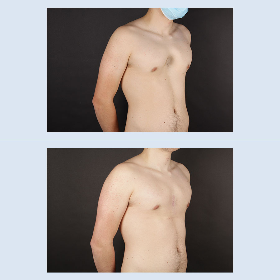 Antes y Después Pectus Excavatum