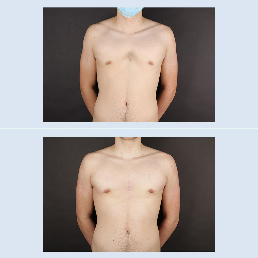 Antes y Después Pectus Excavatum