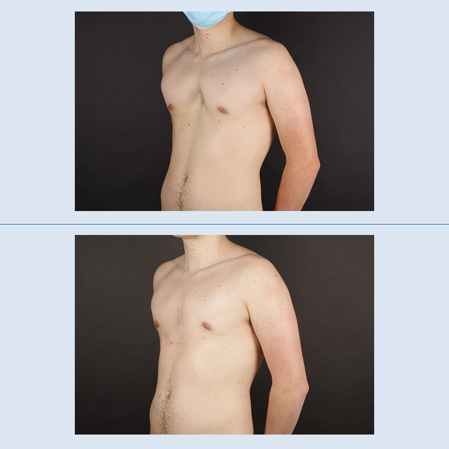 Antes y Después Pectus Excavatum