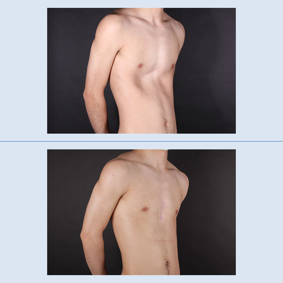 Antes y Después Pectus Excavatum