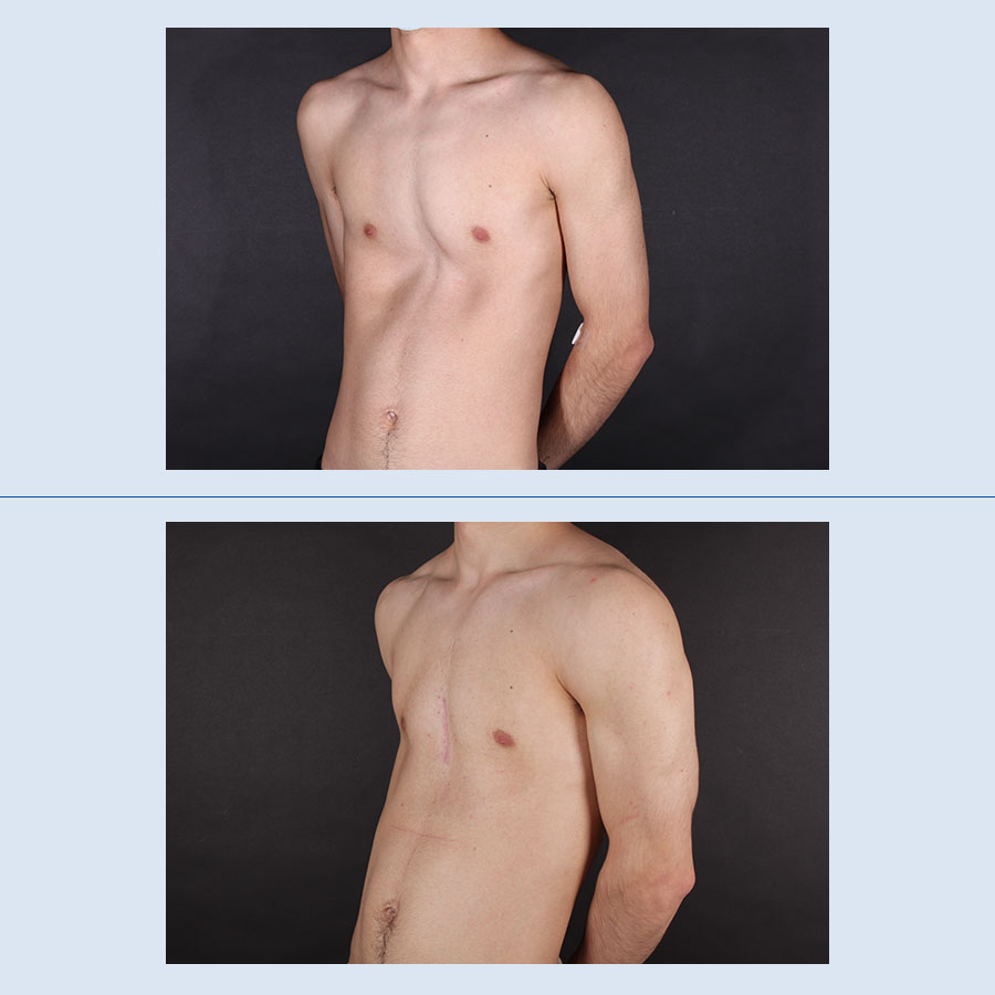 Antes y Después Pectus Excavatum