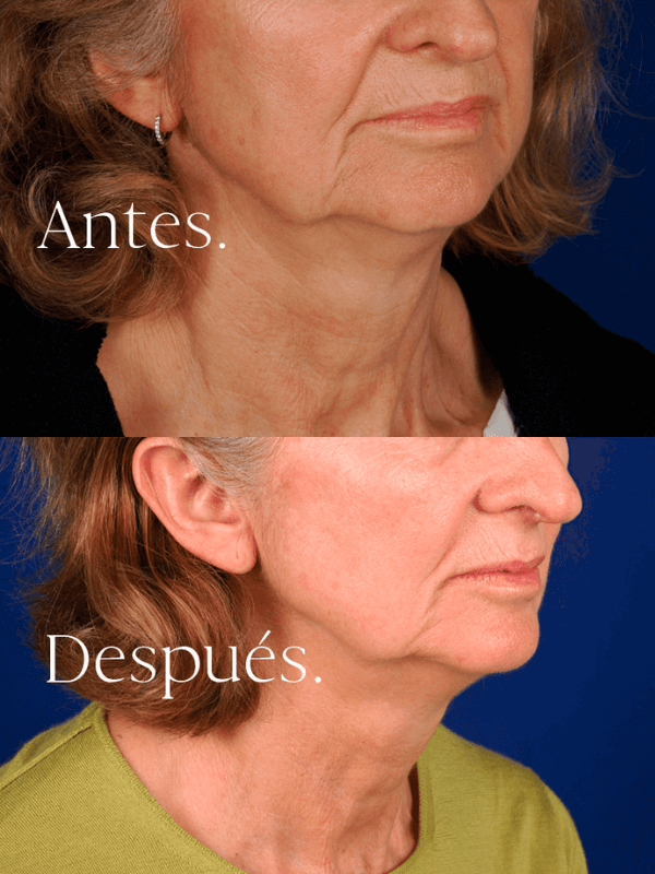 antes-y-despues