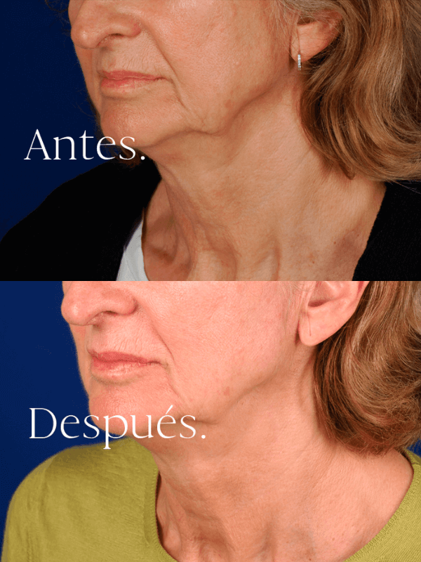 Antes y después HIFU