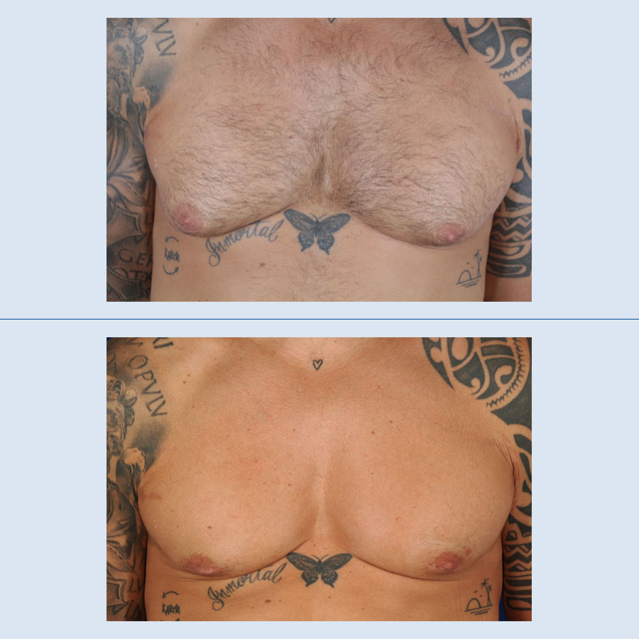 Antes y Después Gynecomastia