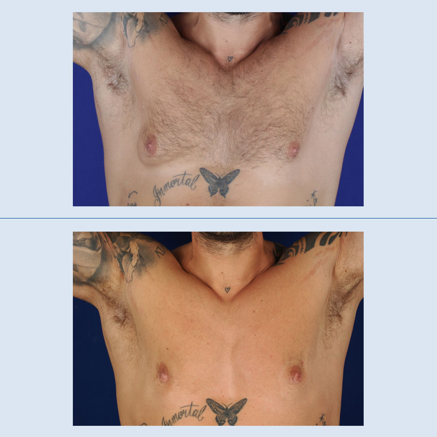 Antes y Después Gynecomastia