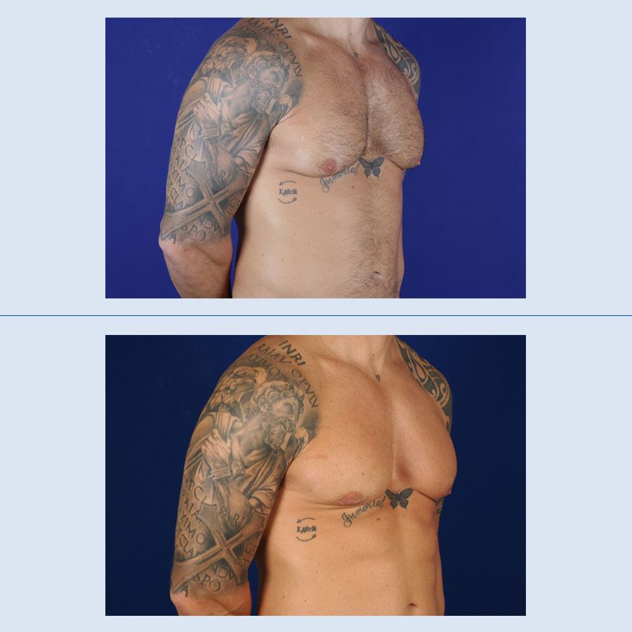 Antes y Después Gynecomastia