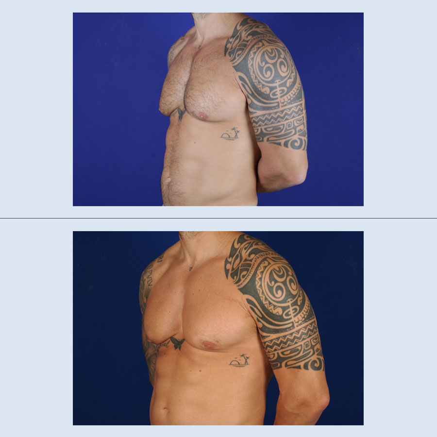 Antes y Después Gynecomastia