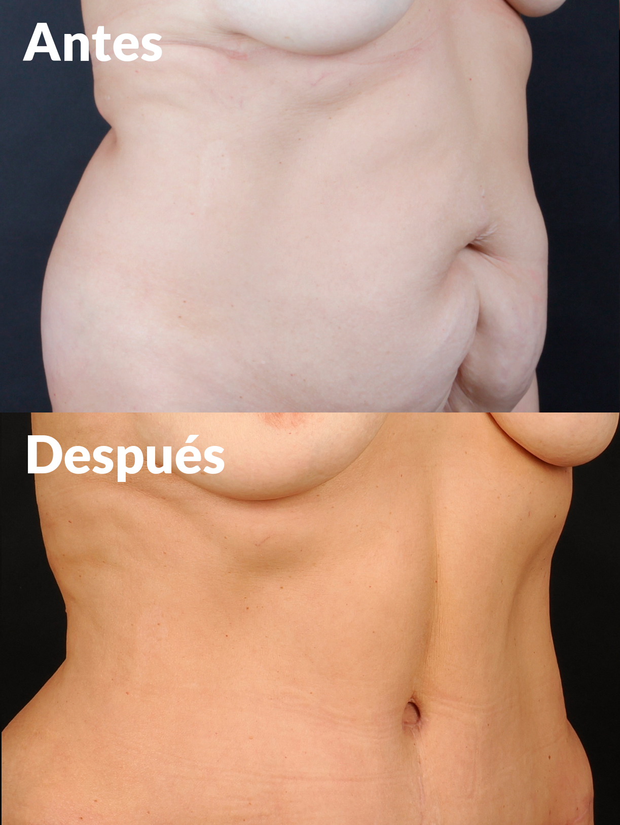 Lipoabdominoplastia antes y después