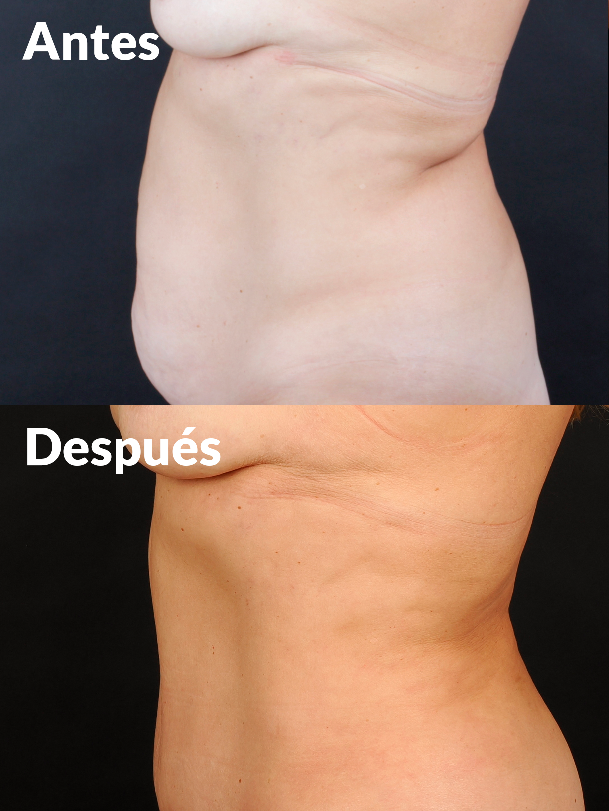 Lipoabdominoplastia antes y después
