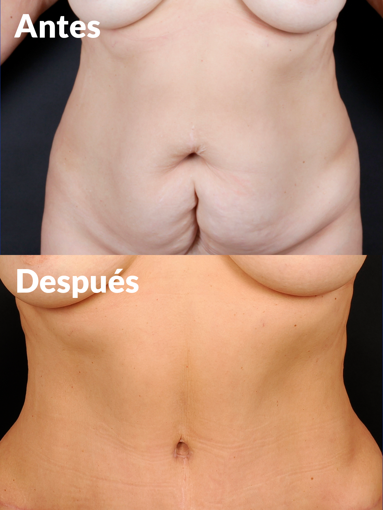 Lipoabdominoplastia antes y después