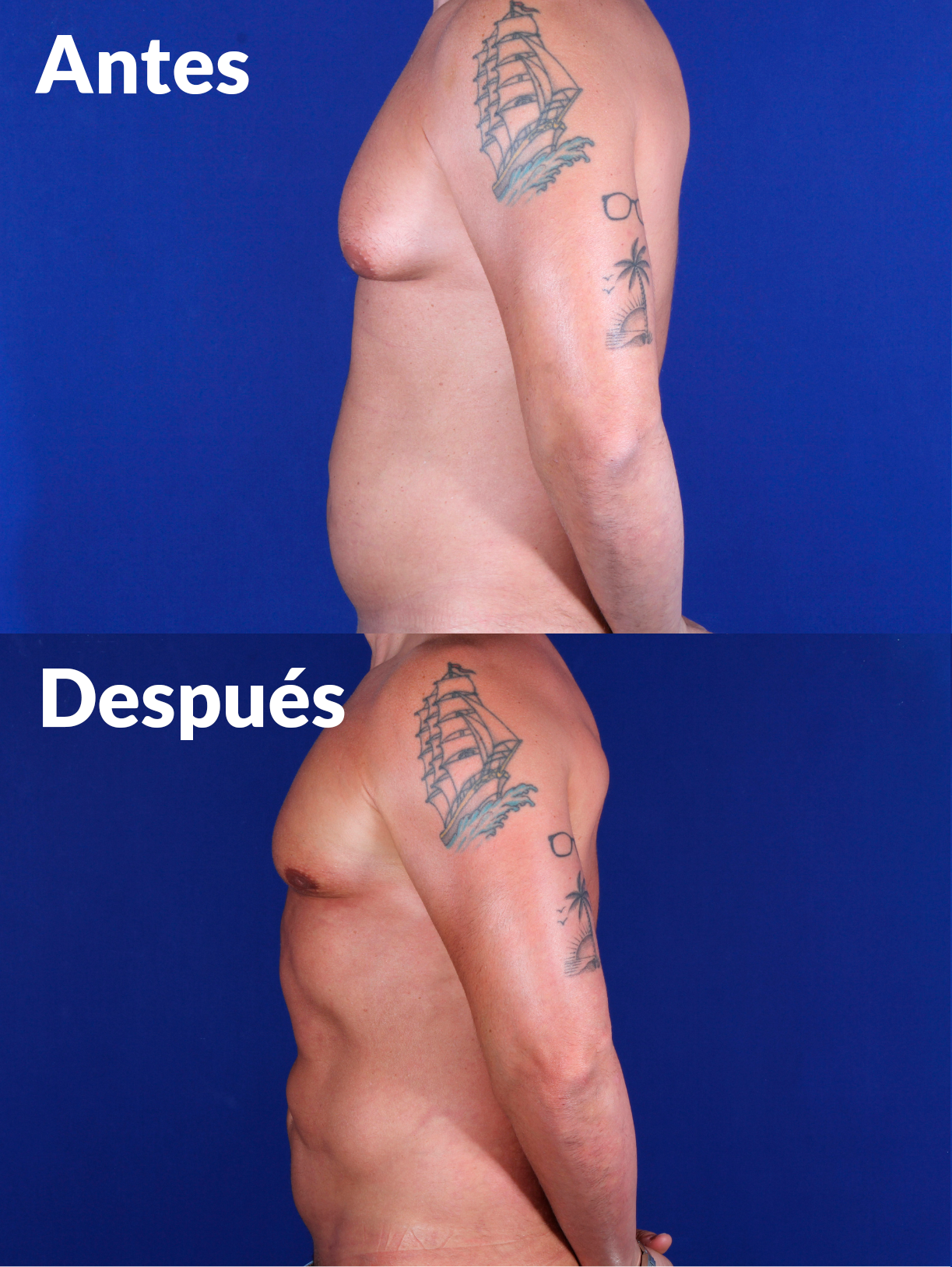 Lipoabdominoplastia antes y después