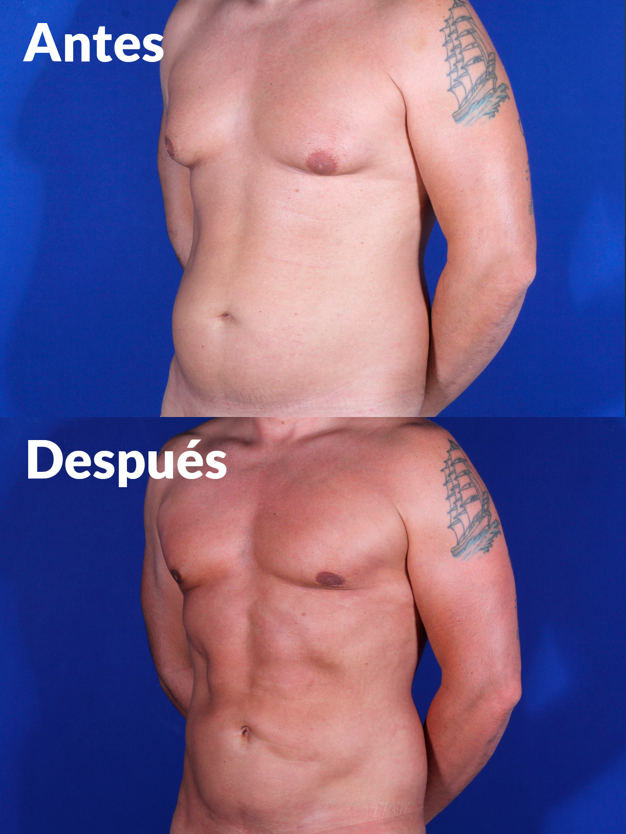 Lipoabdominoplastia antes y después
