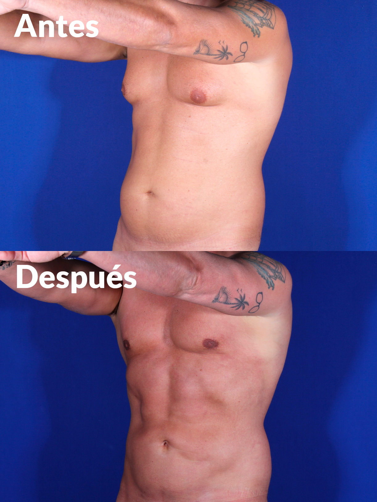 Lipoabdominoplastia antes y después