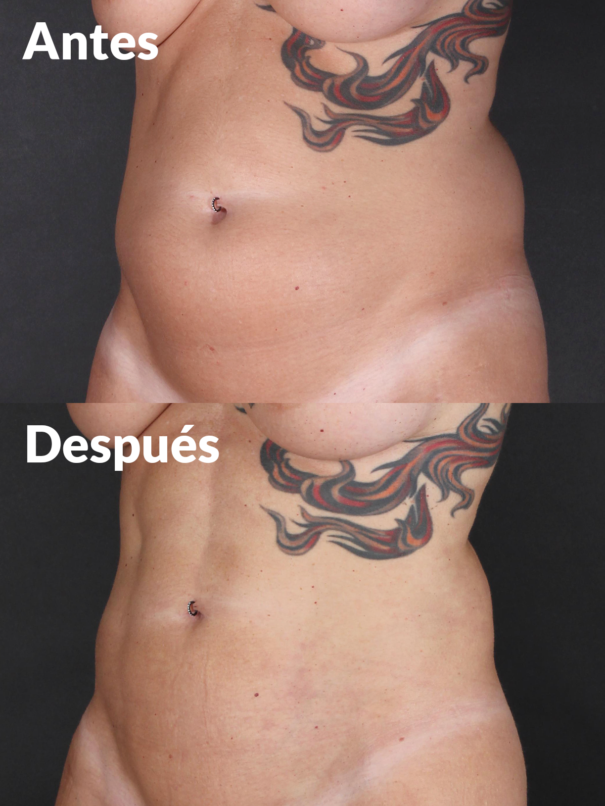 Lipoabdominoplastia antes y después