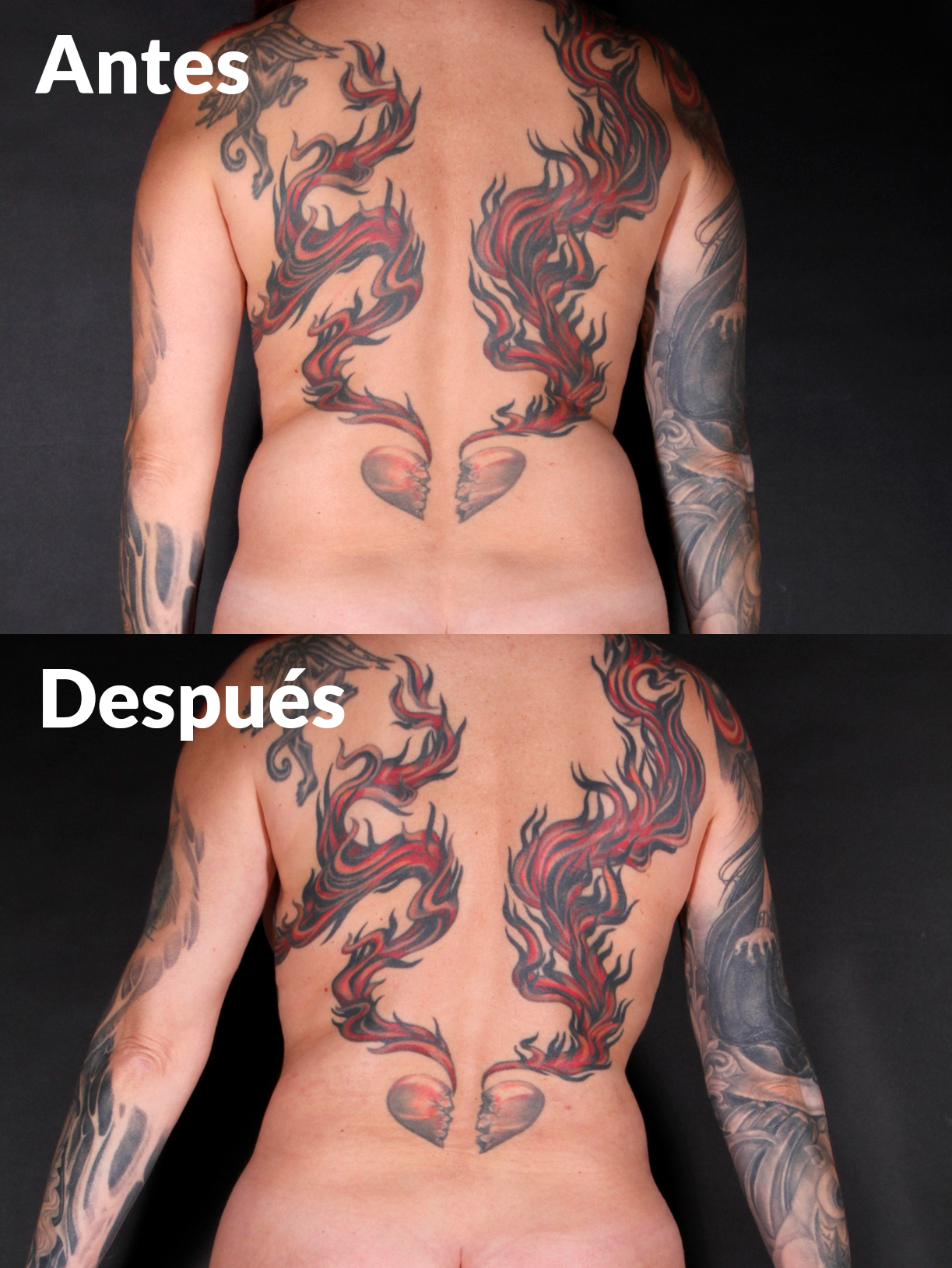 Lipoabdominoplastia antes y después