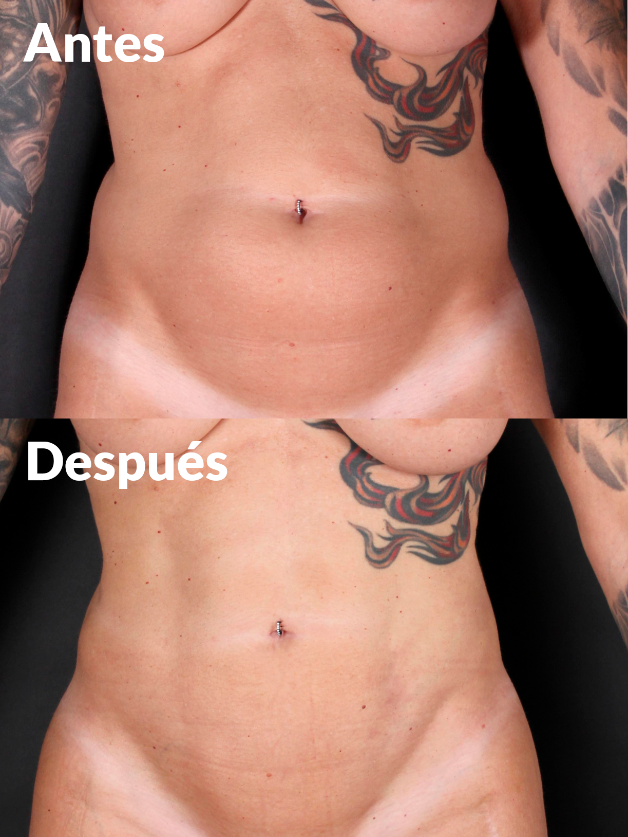 Lipoabdominoplastia antes y después