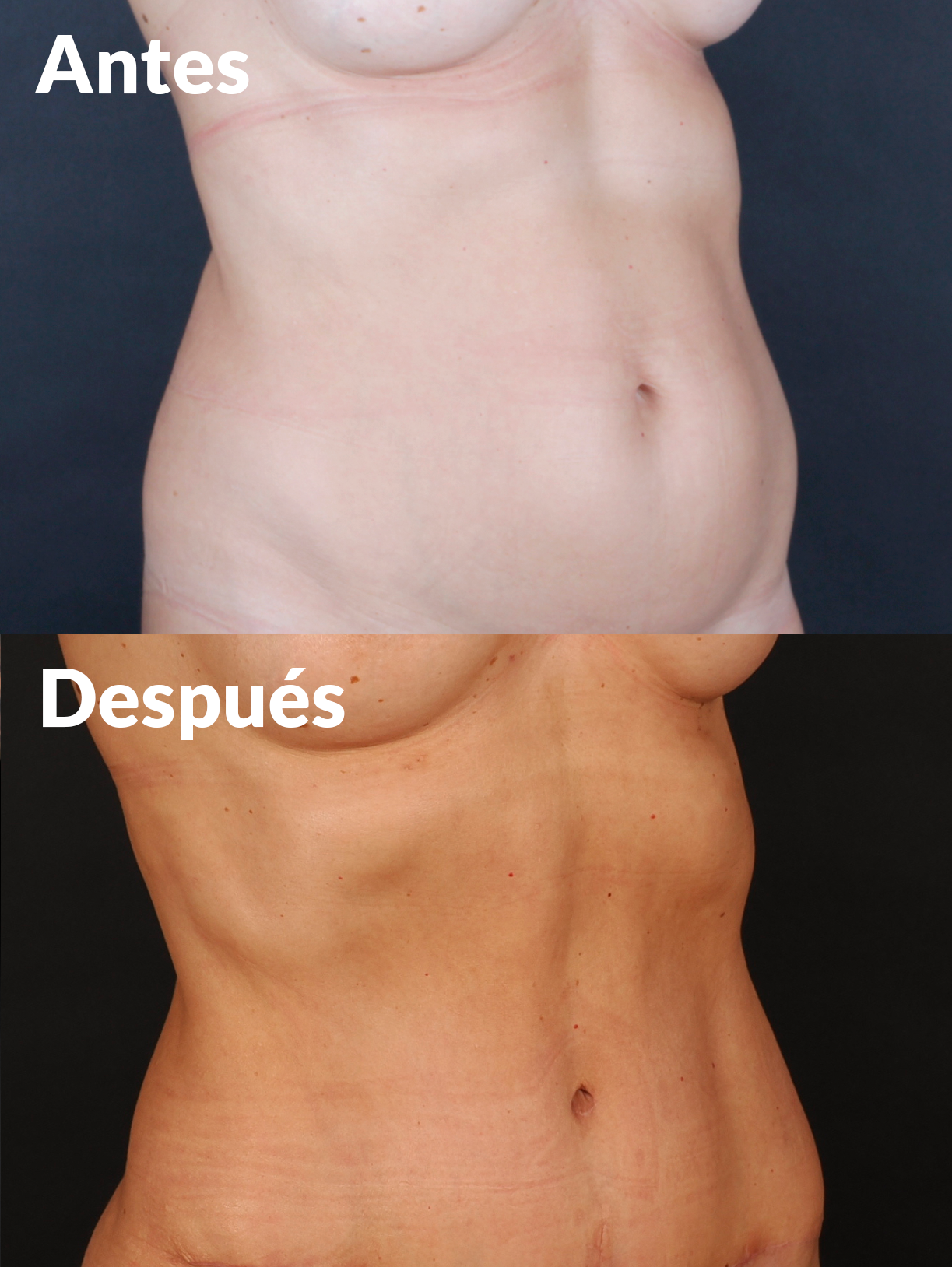 Lipoabdominoplastia antes y después