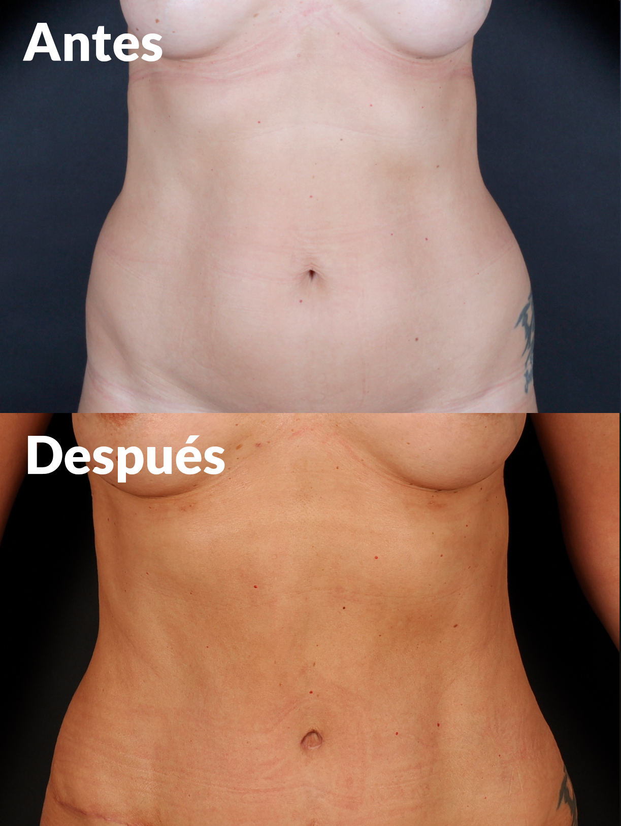 Lipoabdominoplastia antes y después