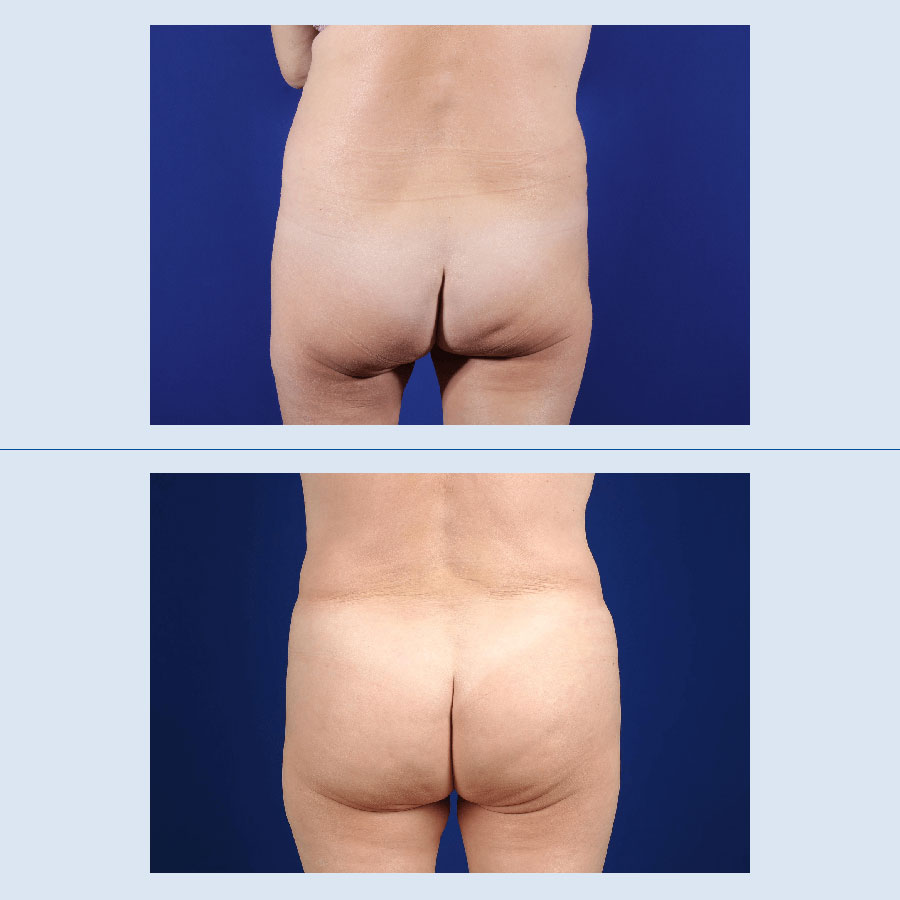 Antes y Después Gluteus Augmentation