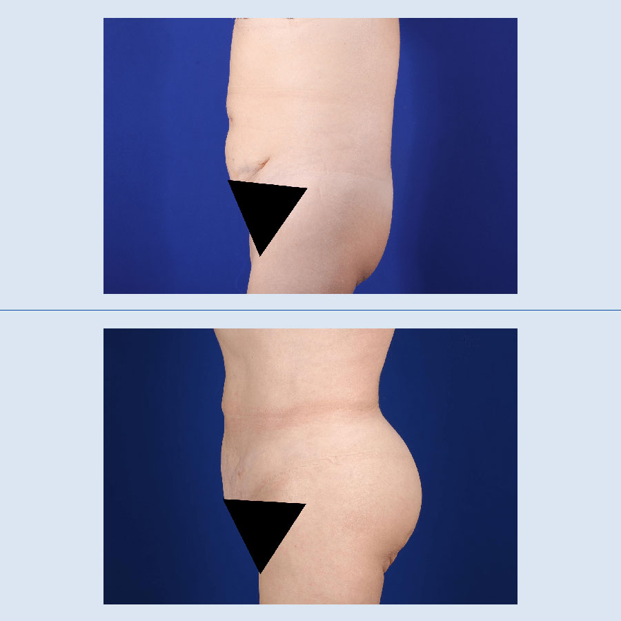 Antes y Después Gluteus Augmentation