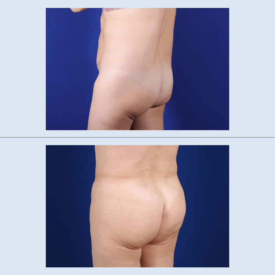 Antes y Después Gluteus Augmentation