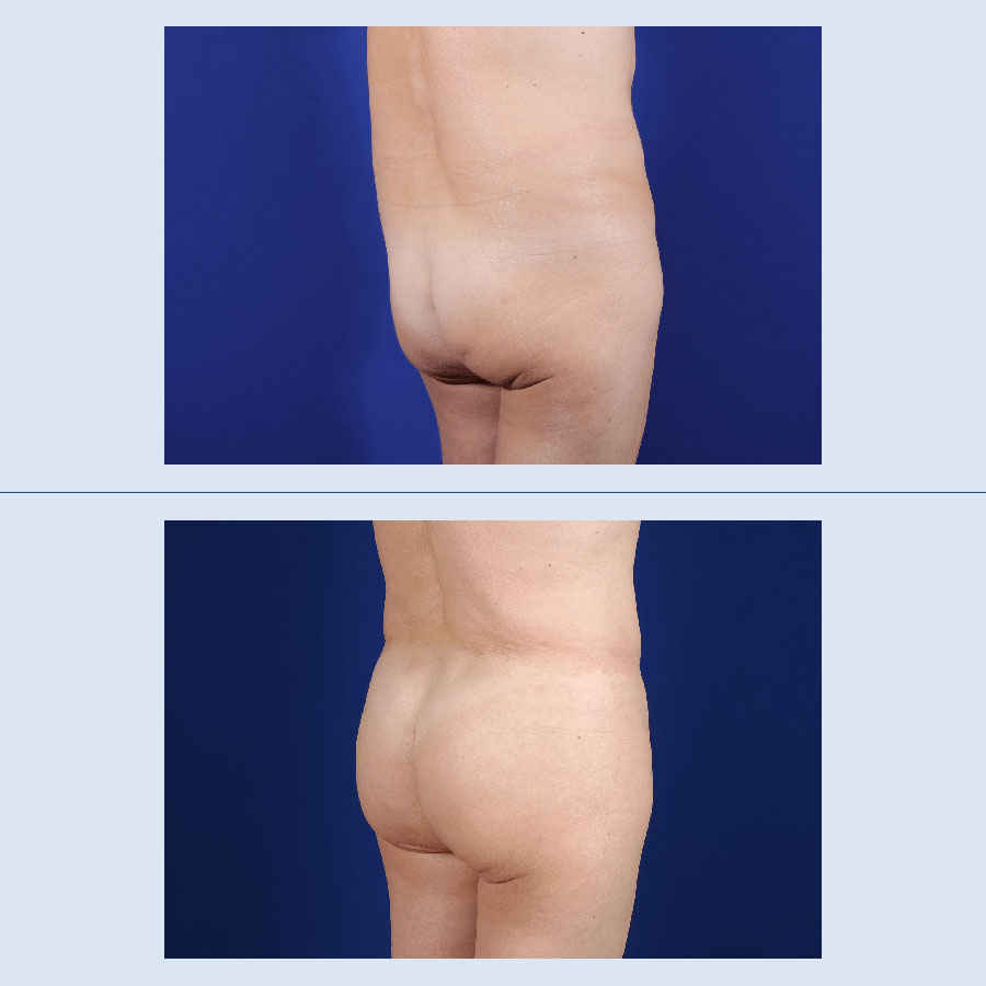 Antes y Después Gluteus Augmentation