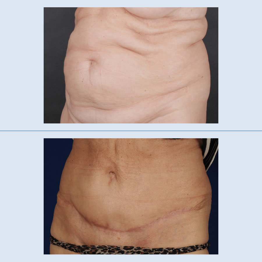 Abdominoplastia - Antes y Después - 4