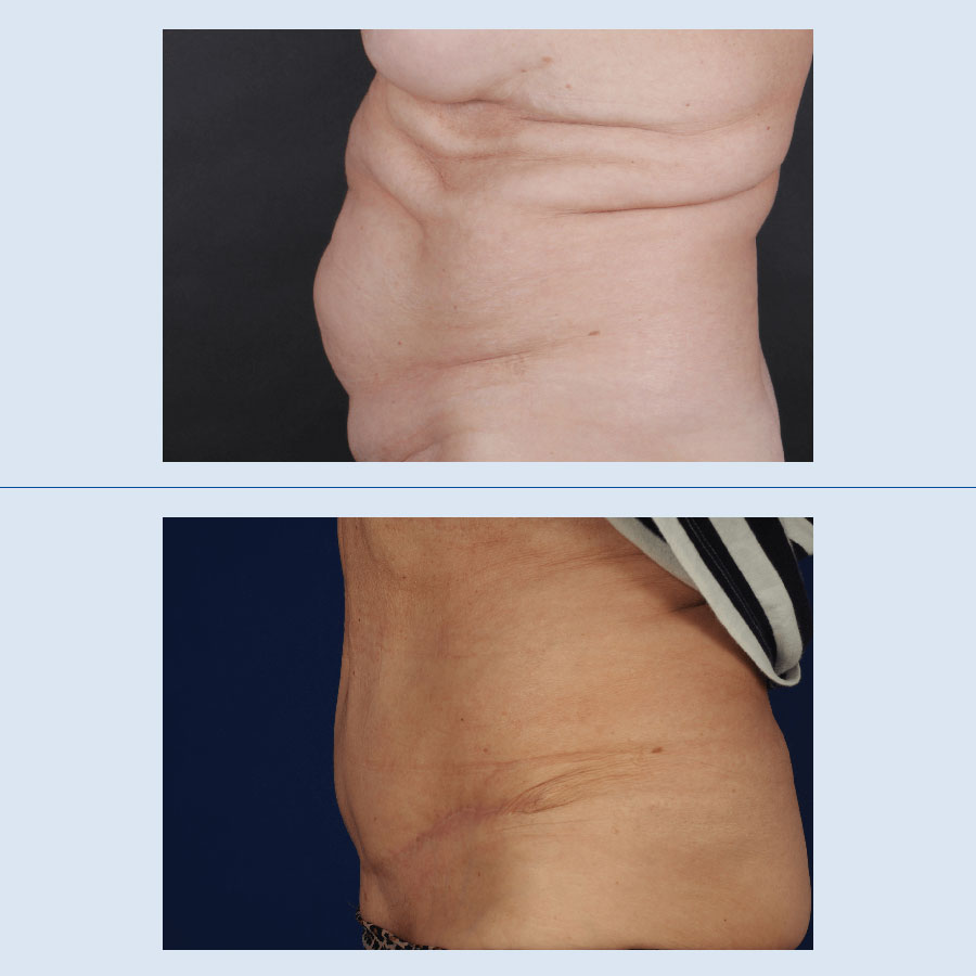Abdominoplastia - Antes y Después - 5