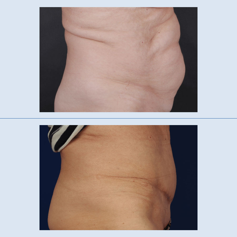 Abdominoplastia - Antes y Después - 6