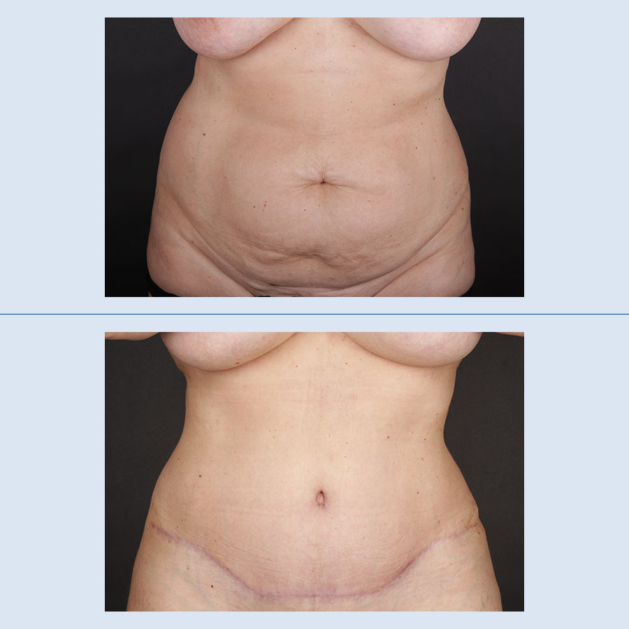 Abdominoplastia - Antes y Después - 1