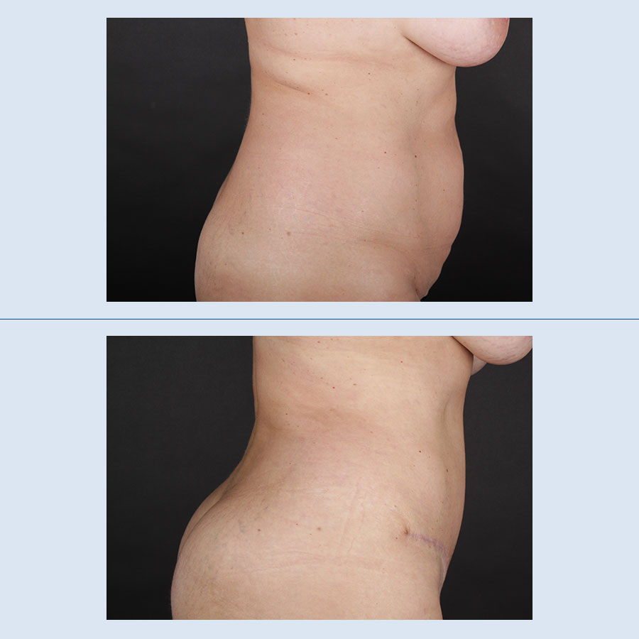 Abdominoplastia - Antes y Después - 2