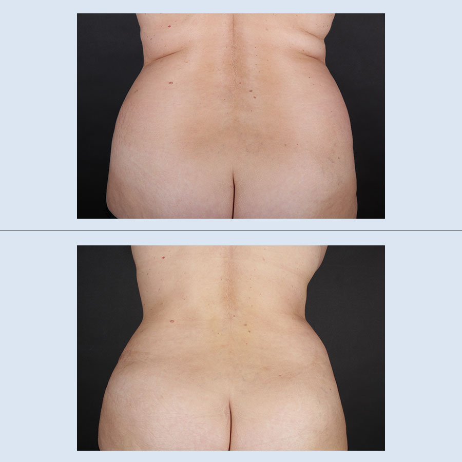 Abdominoplastia - Antes y Después - 3