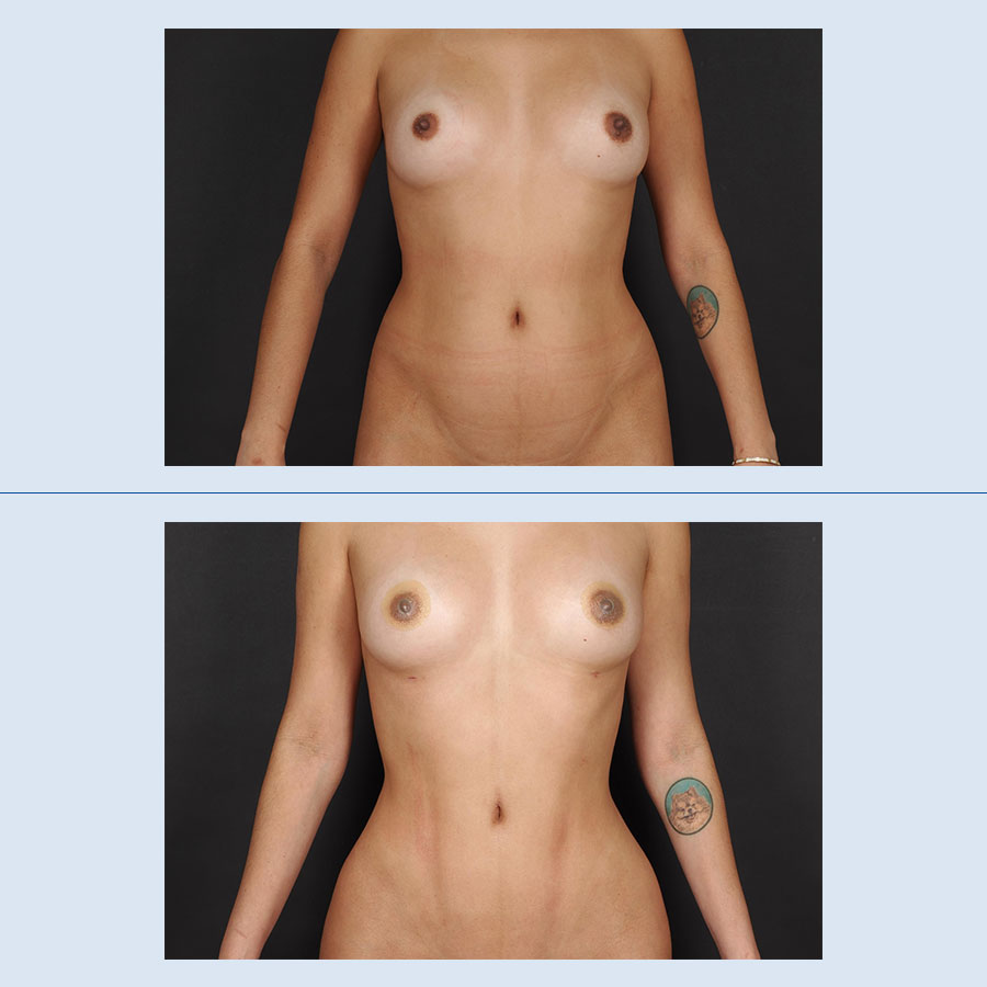 Antes y Después Lipo Vaser