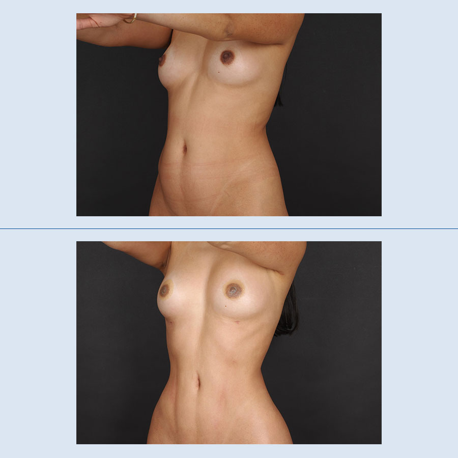 Antes y Después Lipo Vaser