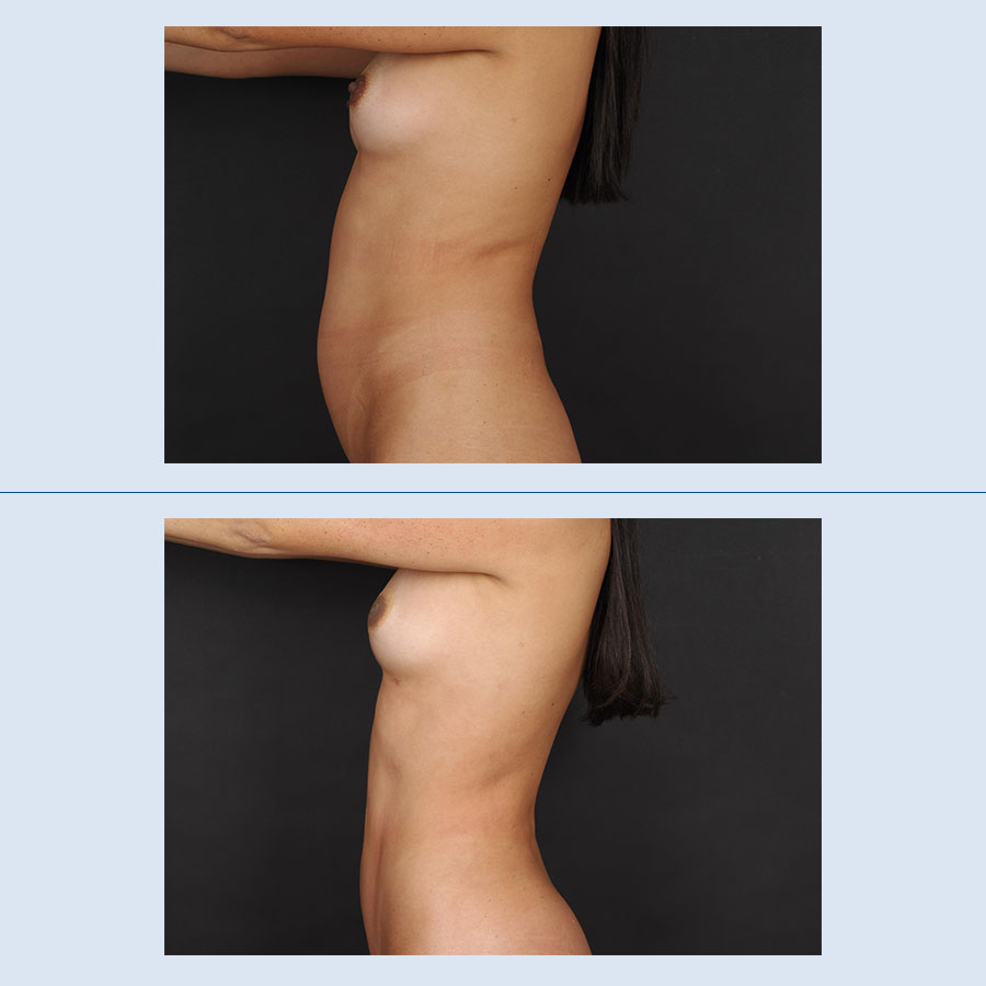 Antes y Después Lipo Vaser