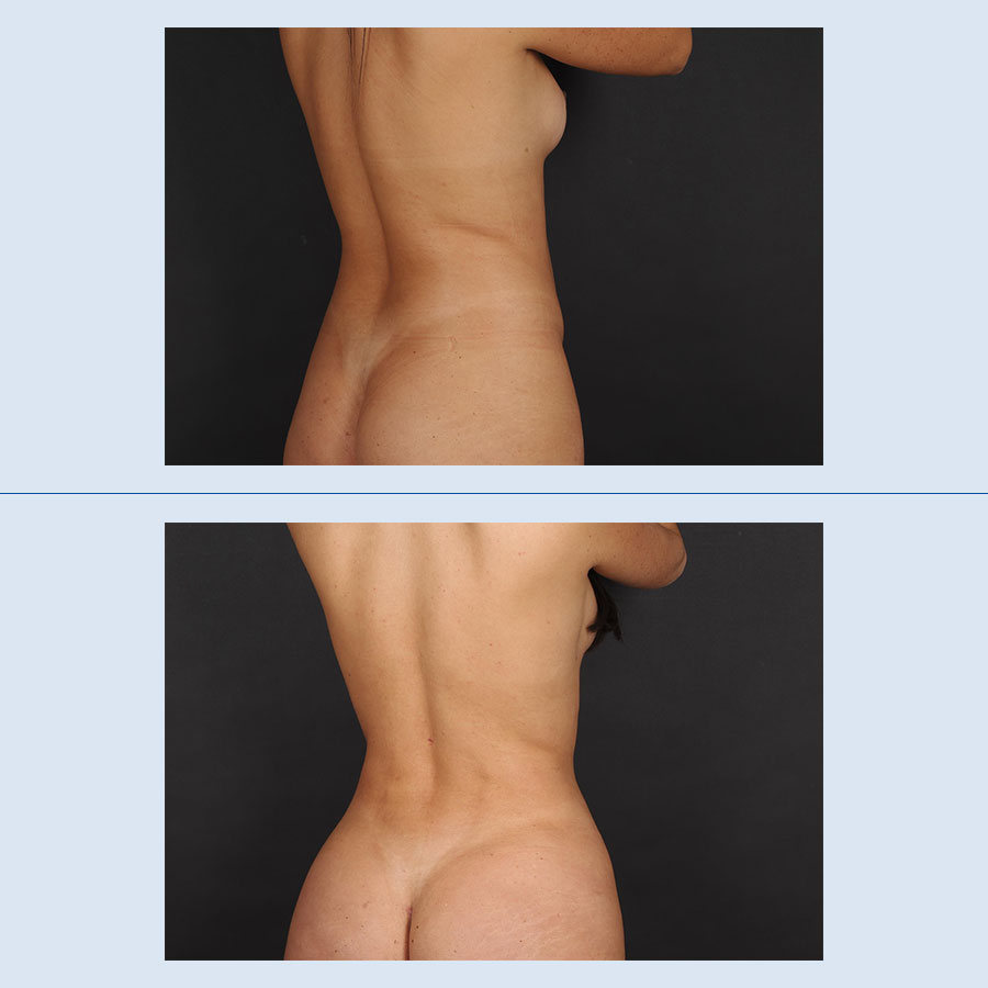 Antes y Después Lipo Vaser