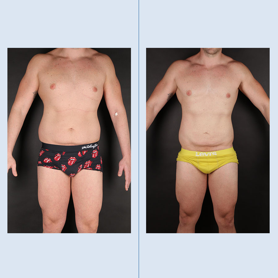 Antes y Después Lipo Vaser