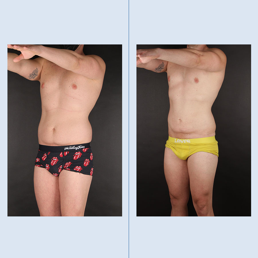Antes y Después Lipo Vaser